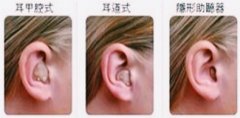 什么是耳内式助听器 它有哪些